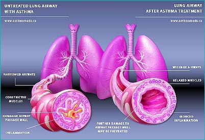 Long term side effects of corticosteroids for asthma